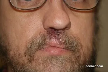 Forhair's patient with cleft lip scar - recovery