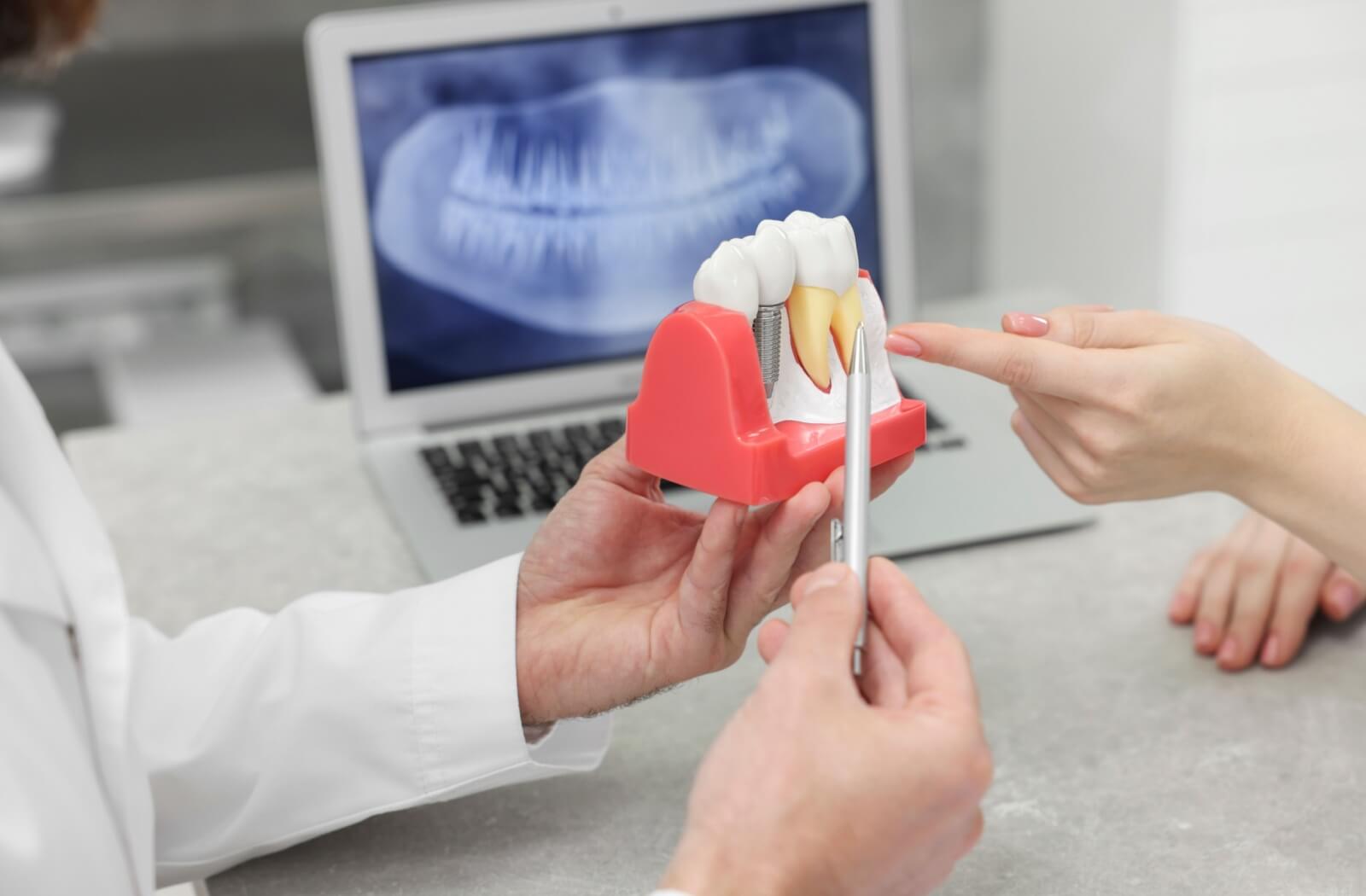 A dentist shares what the dental implant process is like while holding a dental model.