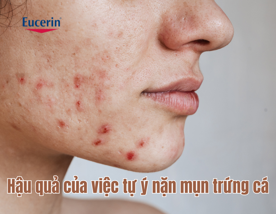  Hậu quả của việc tự ý nặn mụn trứng cá 