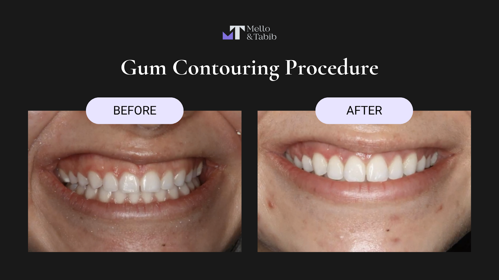 Gum contouring before and after