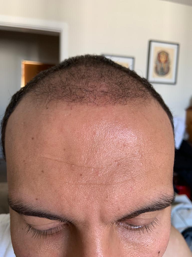 تساقط الشعر المزروع بعد زراعة الشعر - مركز اليت هير لزراعة الشعر