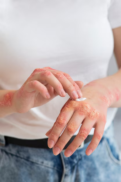 What is Eczema?