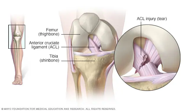 ACL Injury Diagram