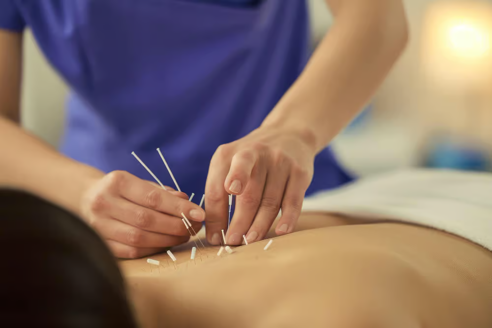 Exploring Back Pain Relief with Acupuncture Encinitas