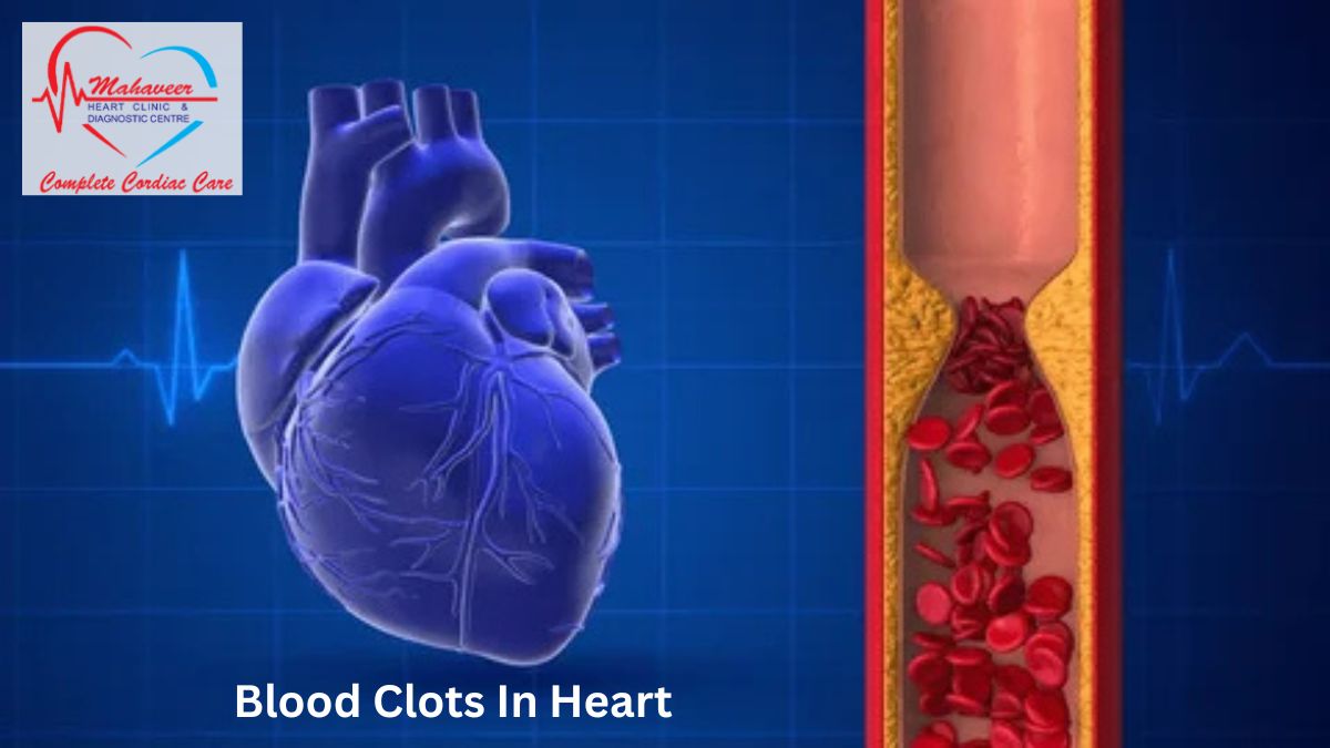 Heart Surgery in Indore for Blood Clotting In Heart by Dr Rakesh Jain