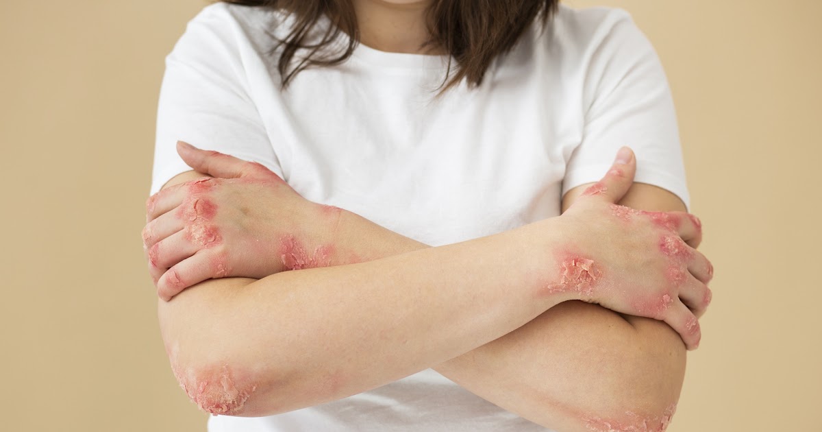 What is Psoriasis? A Complete Guide to Causes & Treatment