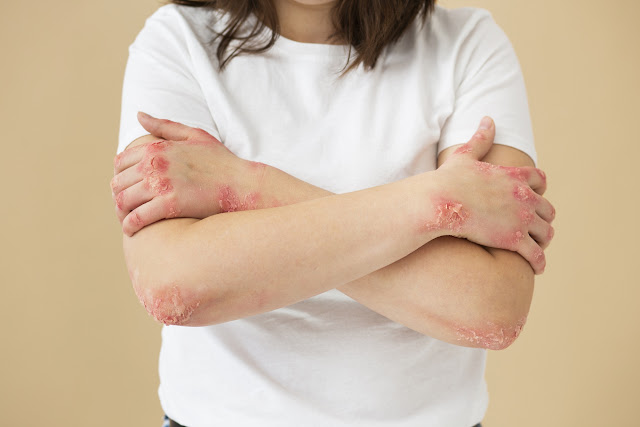 What is Psoriasis