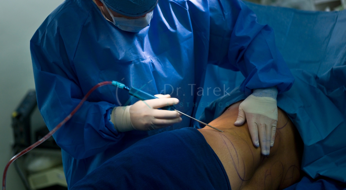 What Is Vaser Liposuction Procedure