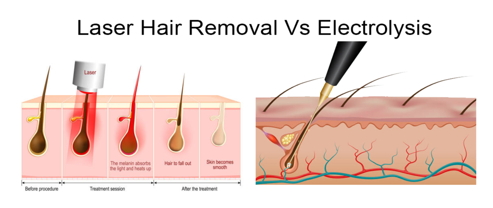 A picture of a diagram of electrolysis  hair removal vs laser hair removal