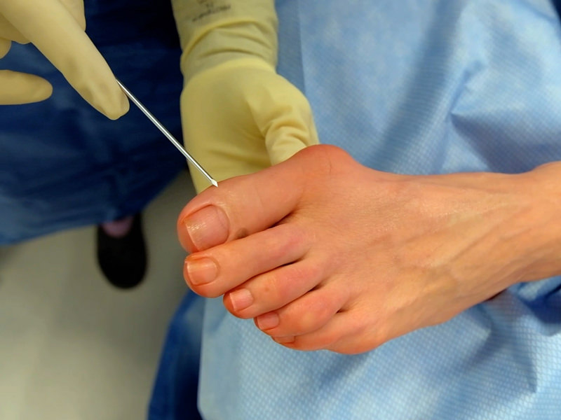 hallux-valgus-chirurgie-se-faire-operer