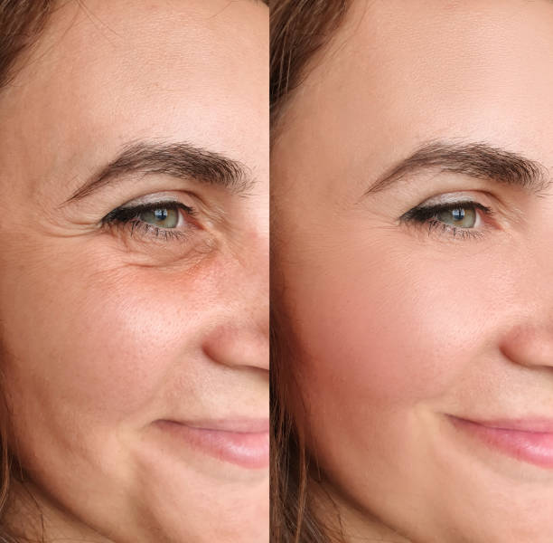 Botox Treatment in Pune