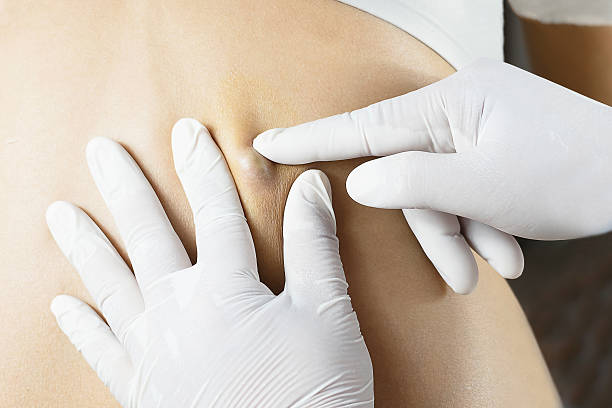 Epidermoid Cyst Removal