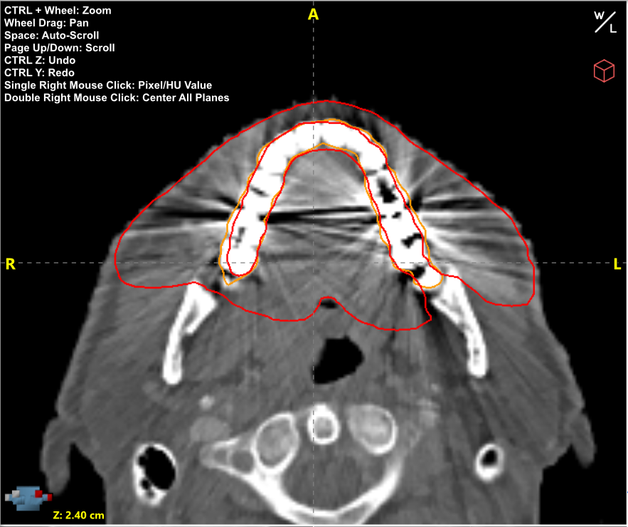 Radformation AutoContour Teeth Artifact