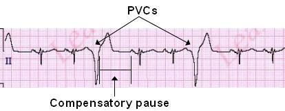 Premature Ventricular Contractions (PVCs) ECG Review | Learn the Heart