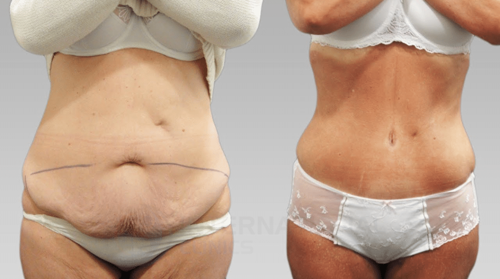 High BMI Plus Size Lipo 360 Before and After