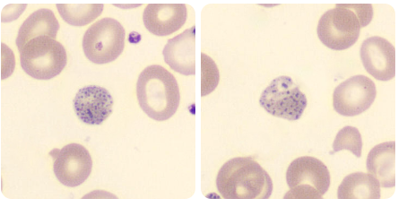 anemia de Fanconi