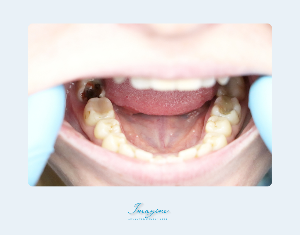 What is Periodontitis?