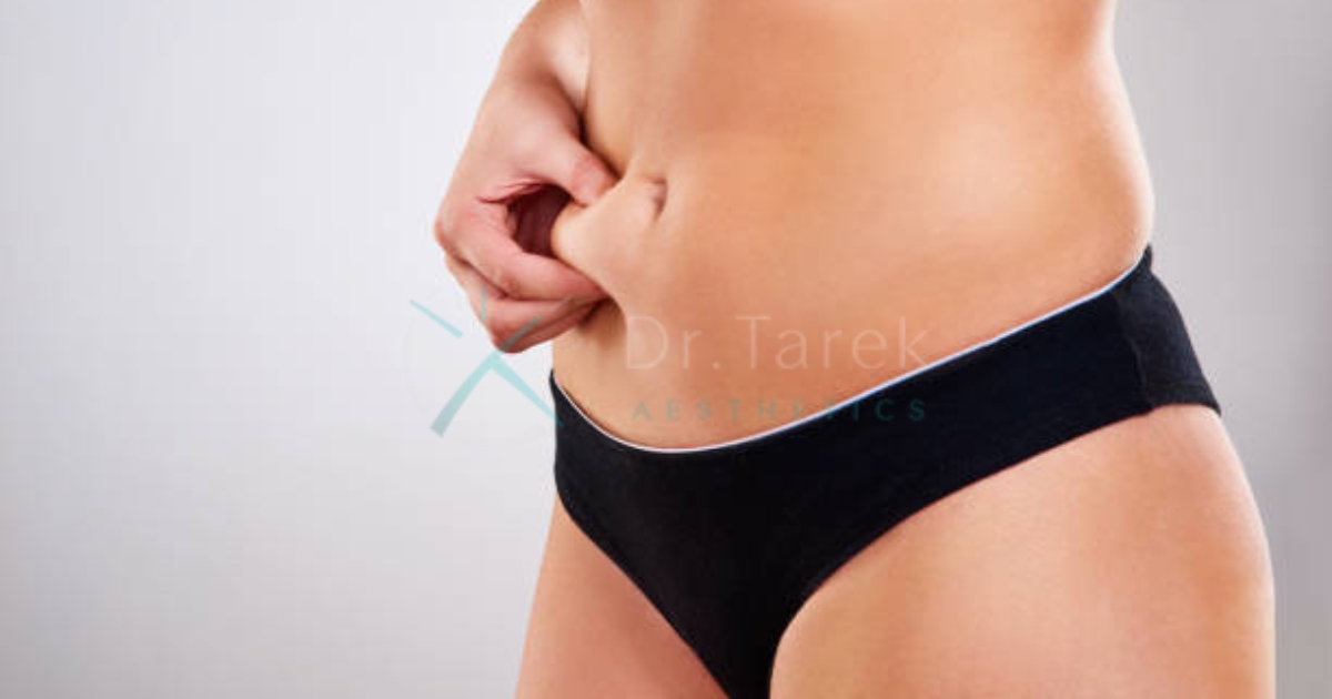 Are Liposuction Results Permanent 5 Dr. Tarek Aesthetics | Best Plastic Surgeon In Dubai Are Liposuction Results Permanent
