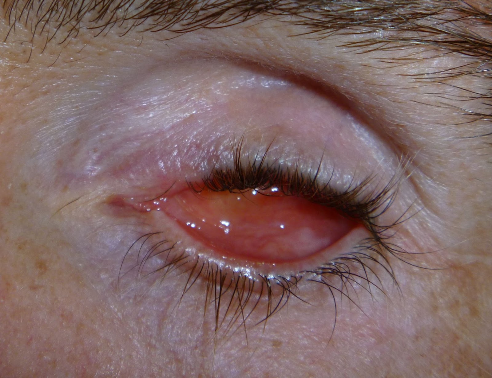 Post-Enucleation Eye Appearance Showing Surgical Removal Outcome