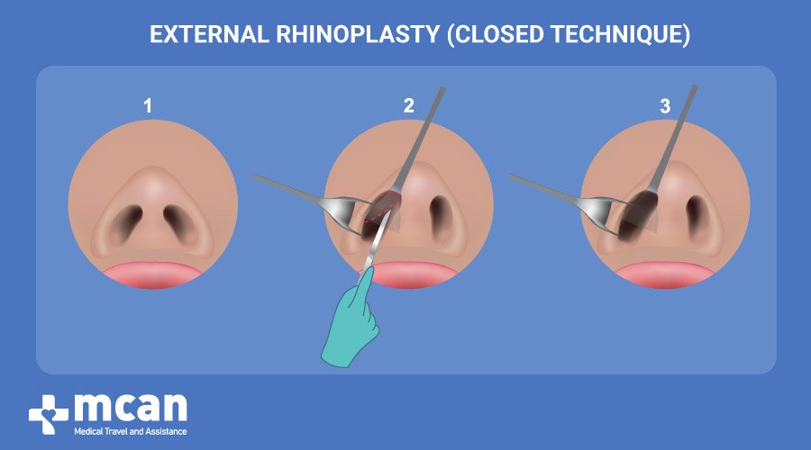 External nose job in Turkey performed by the best surgeons | MCAN Health