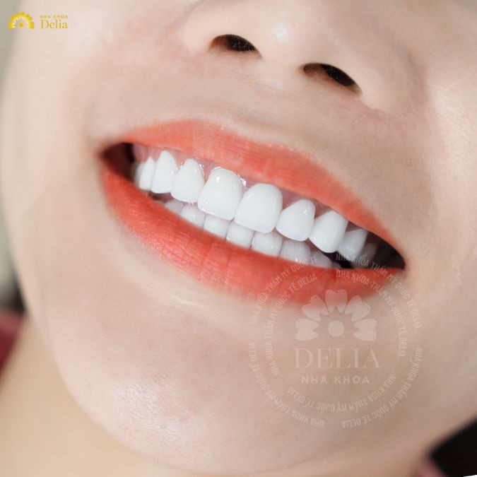 Quy trình làm răng sứ tại nha khoa Delia