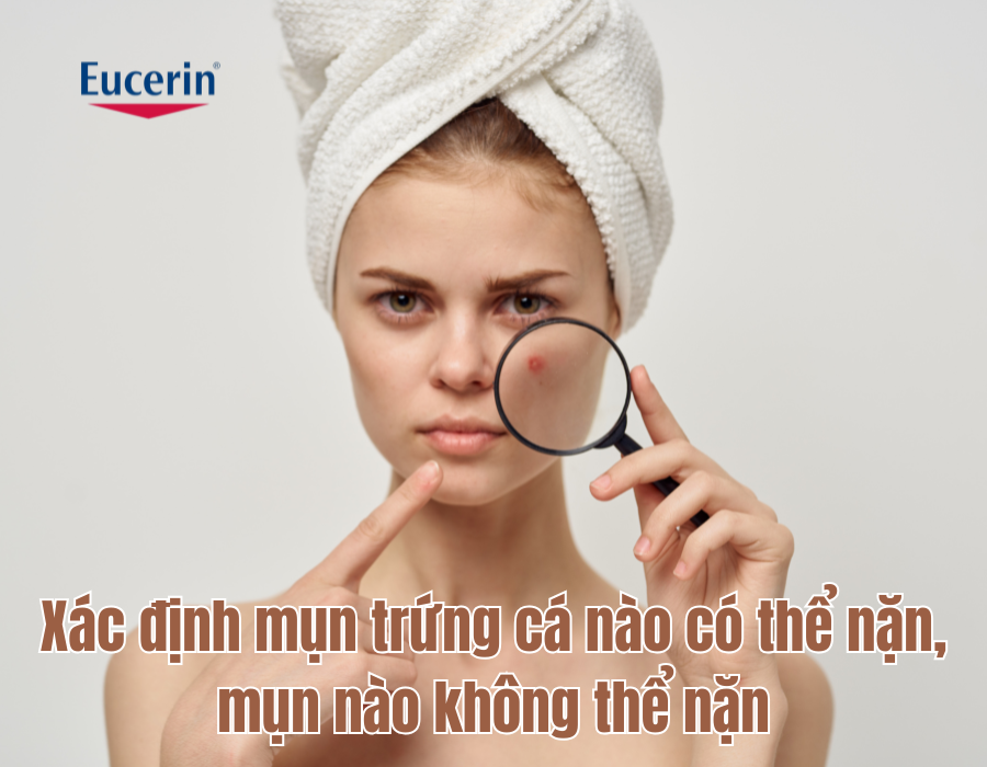  Xác định mụn trứng cá nào có thể nặn, mụn nào không thể nặn 