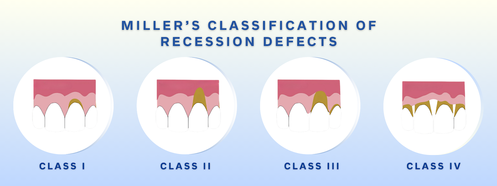 Mr. Bur Soft Tissue Trimming Ceramic Powder Bur FG for precise soft tissue contouring in gingival recession treatment, ideal for procedures aligned with Miller’s classification of recession defects.