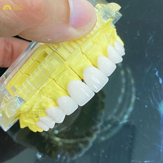 khung sườn sứ với độ bền và độ khít sát cao