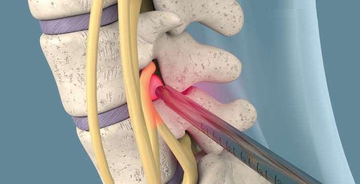 Endoscopia de Coluna Especialista em Cirurgia de Coluna
