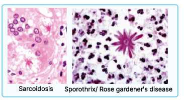 Restrictive Lung Diseases in NEET PG Pathology