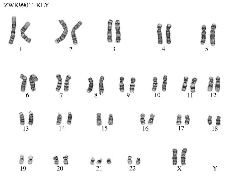 C:\Users\nicolaou.s\Dropbox\1. RESEARCH PROJECTS\EDUCATION\1. Strategic partnership\0. March 2023\WPs\WP3\Case studies\Biostatistics and probabilities\Maria feedback\Trisomy 21.jpeg
