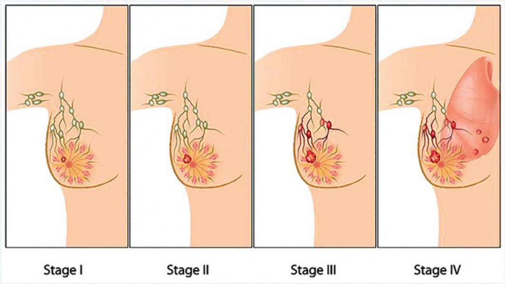مراحل سرطان الثدي