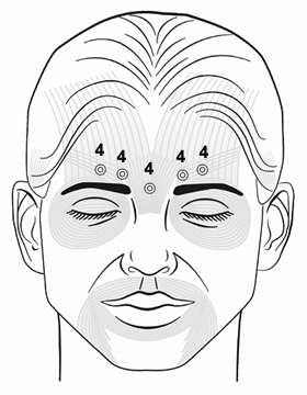 Botox Training Glabellar Injection Pattern