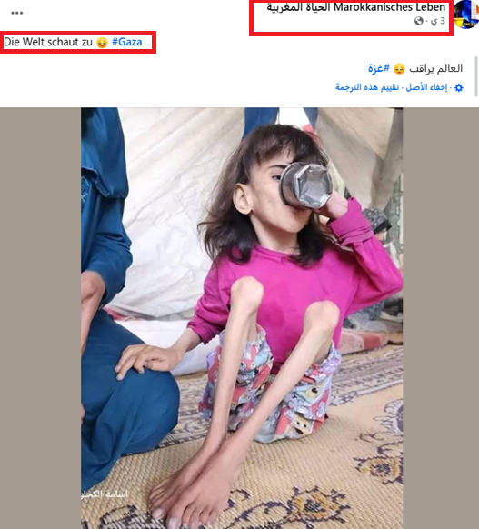 Malnourished Gazan Girl