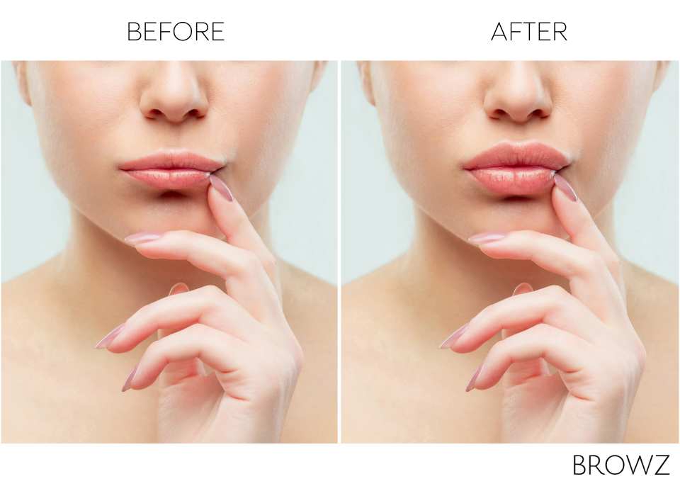 Before and after results of a lip filler procedure.