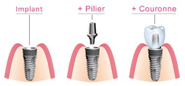 C:\Users\Acer\Pictures\implant-dentaire-hongrie.jpg معلومات عامة عن زراعة الأسنان