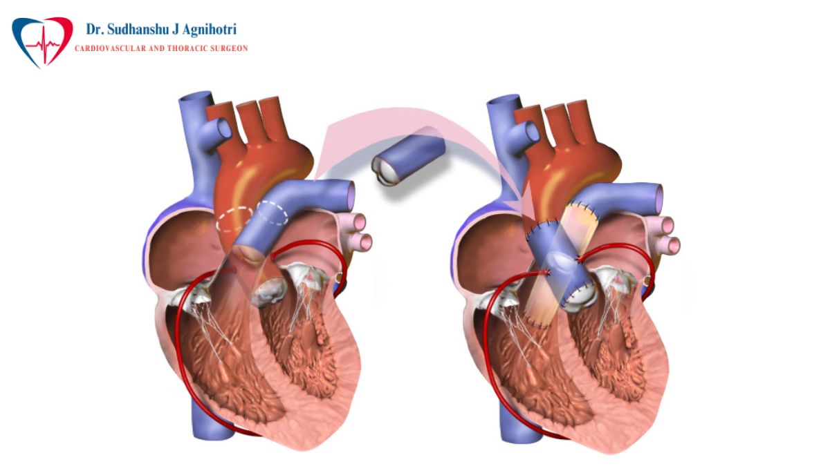 Reoperative Heart Surgery - Dr Sudhanshu J Agnihotri - Cardiac Specialist Near Me