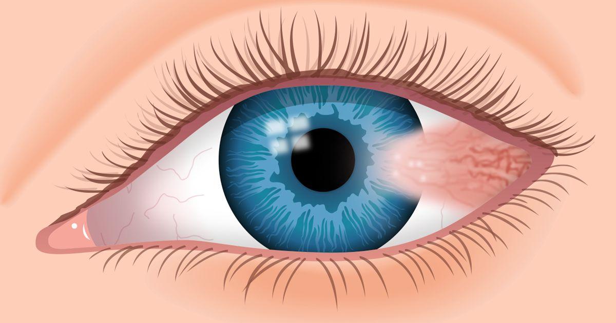 Pterygium: What Is Surfer's Eye?