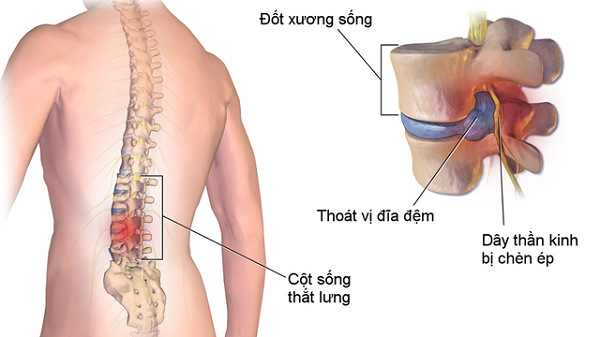 Giải pháp dành cho người mắc bệnh xương khớp