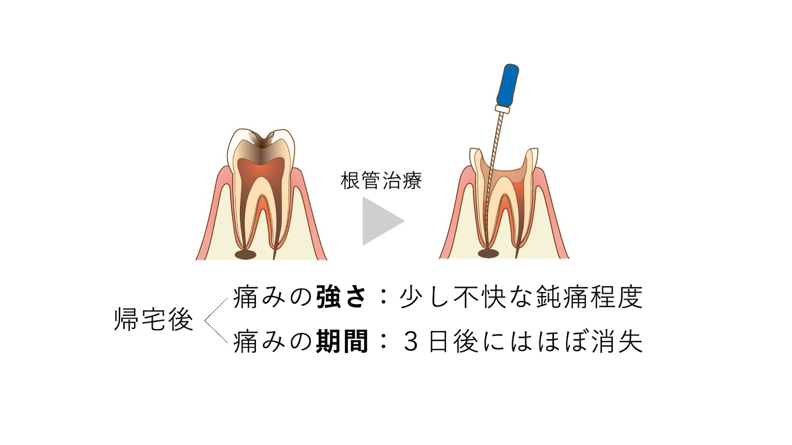 痛みの程度や持続期間の目安。根管治療の帰宅後、痛みの強さは少し不快な鈍痛程度、痛みの期間は3日後にはほぼ消失する、といったことがほとんどです。