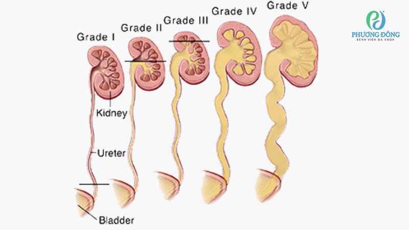 Các cấp độ trào ngược bàng quang niệu quản