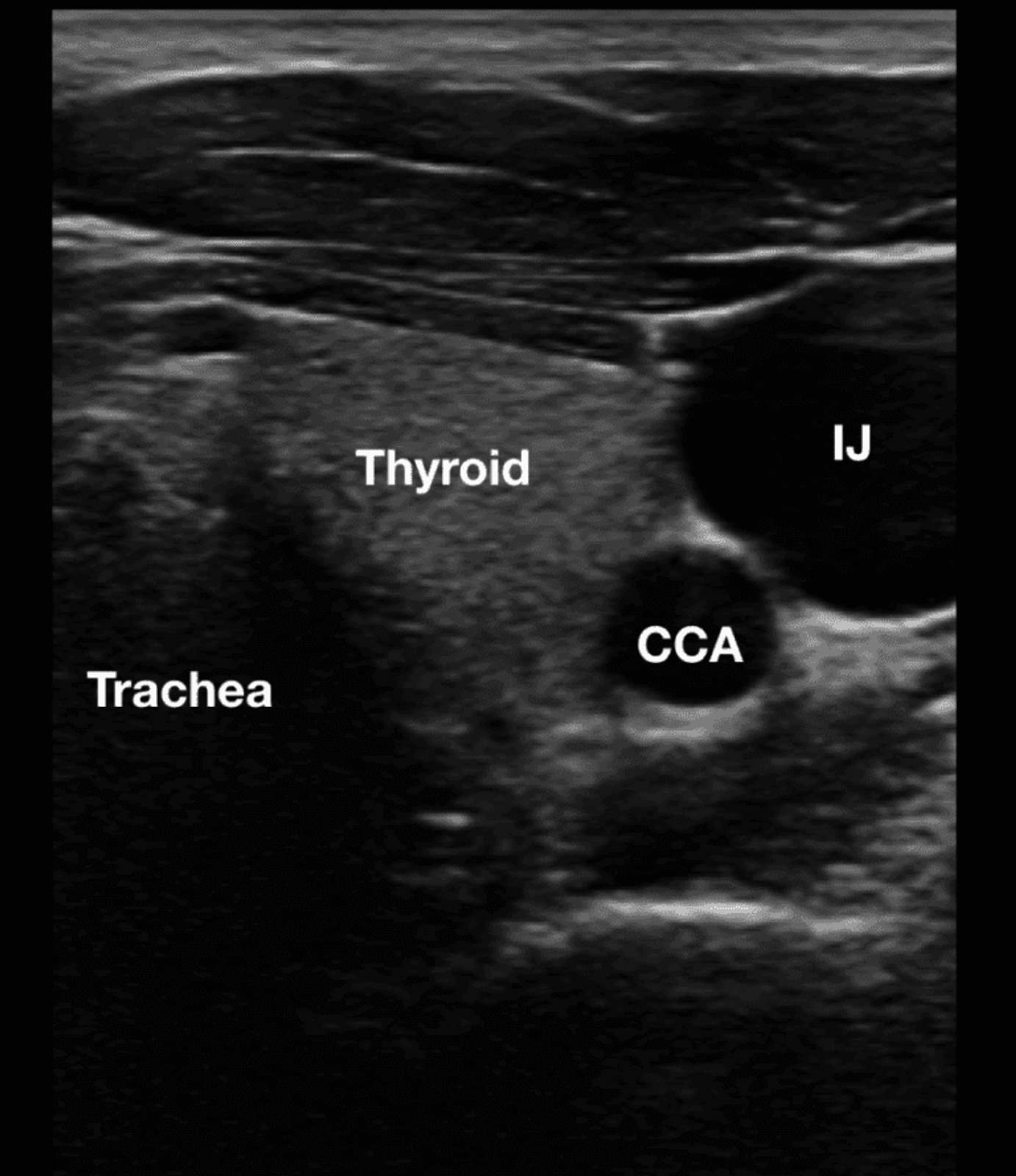 Giải phẫu siêu âm - TM cảnh trong (IJ) và ĐM cảnh trong (CCA).