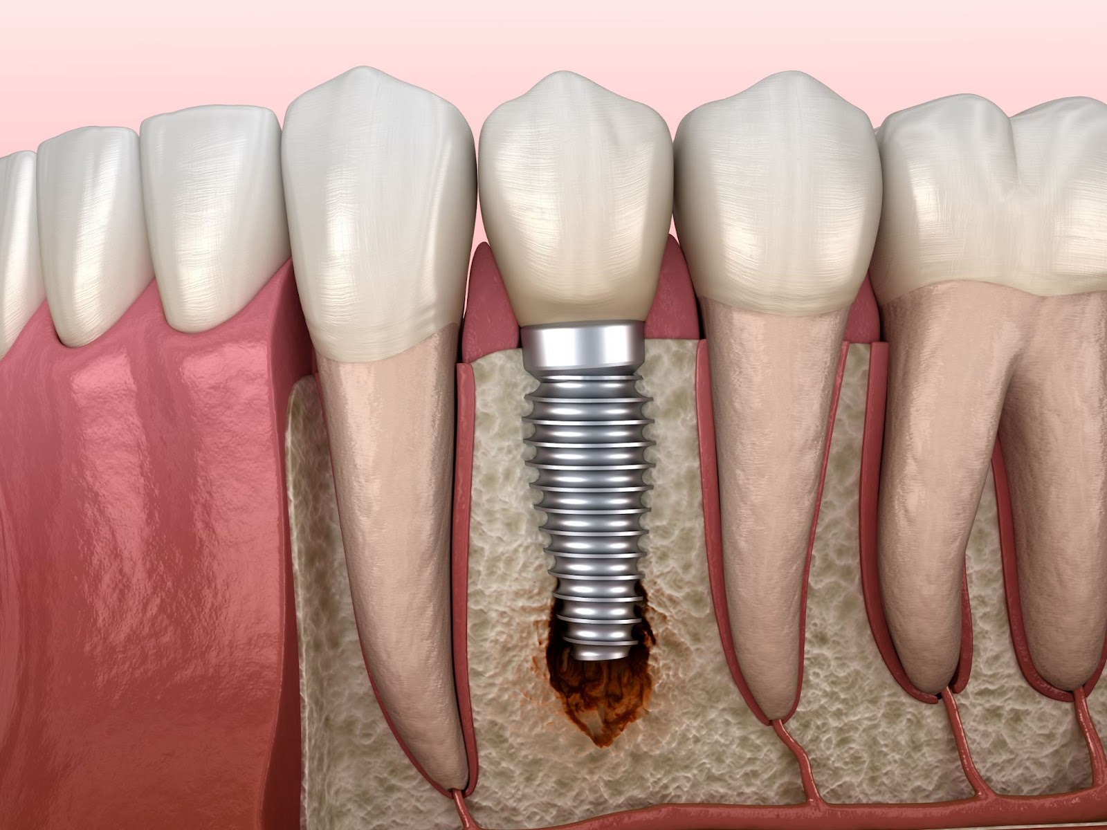 periimplantita