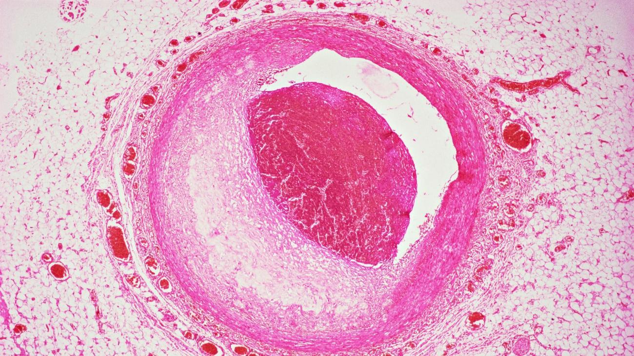 Angioplastia: saiba o que é e como funciona o tratamento