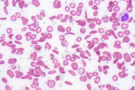 Sickle Cell Anemia | Peripheral blood smear | Ed Uthman | Flickr