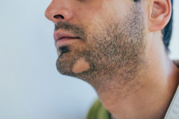 Understanding Common Beard Growth Challenges