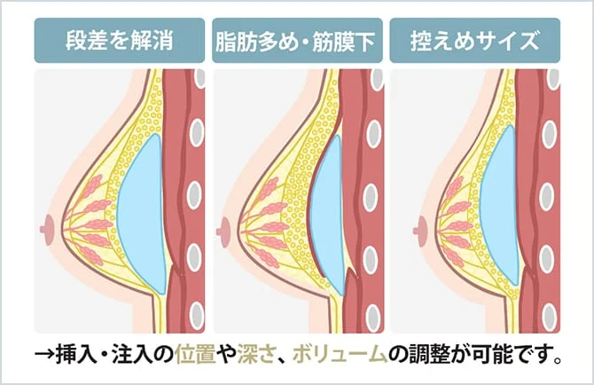 入れ方によりバストのデザインを変えられるハイブリット豊胸