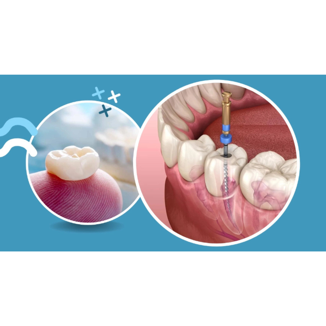 Can a Root Canal Be Done Through a Crown by Skilled Boston Dentists?