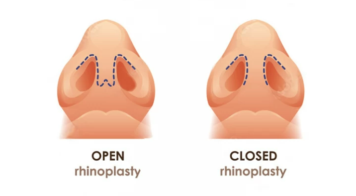 picture describe the difference between open and closed thinoplast 