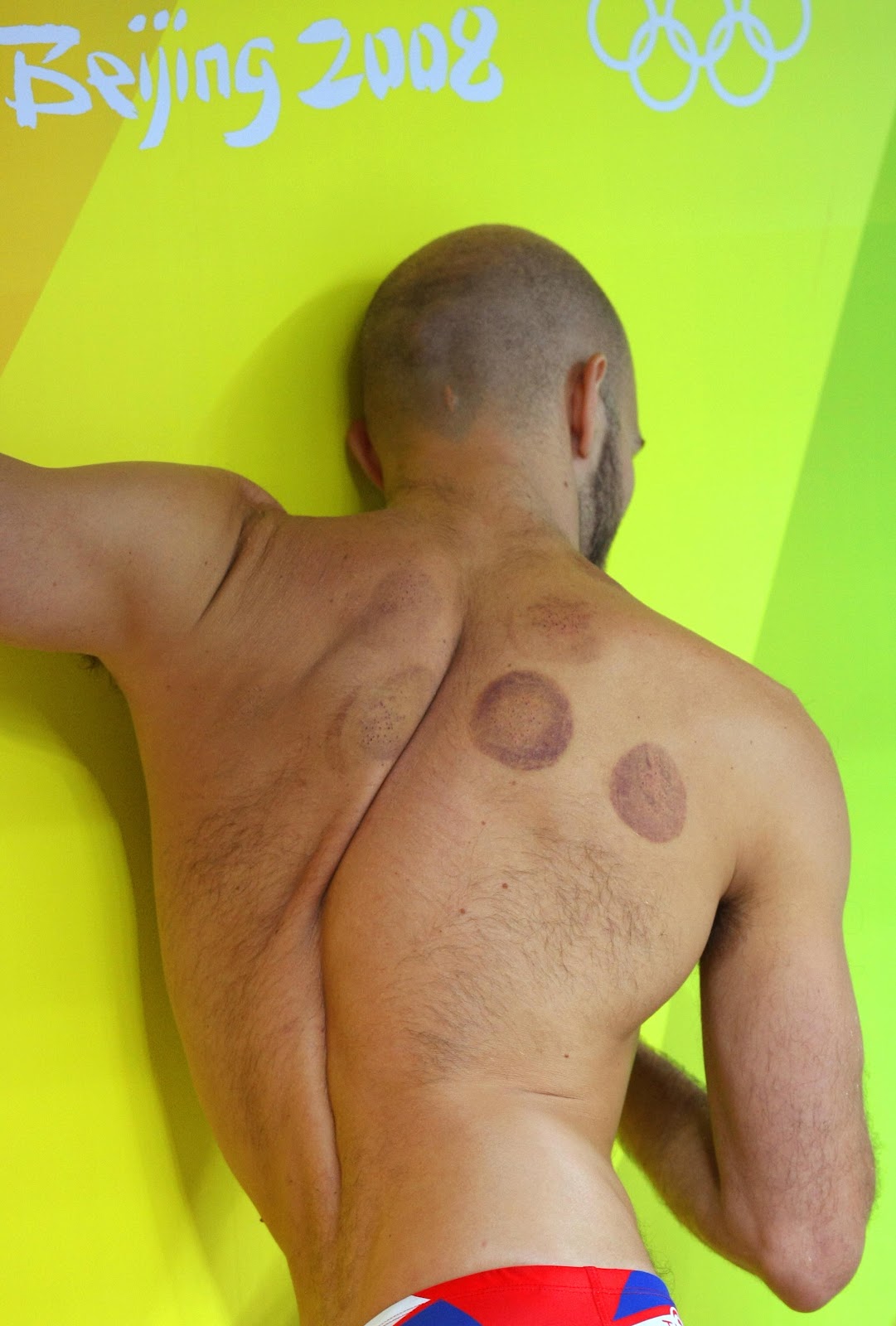 An unidentified swimmer seen with circular cupping marks prepares for a training session at the National Aquatics Center, in preparation for the 2008 Beijing Olympic Games, in Beijing, on August 7, 2008. | Source: Getty Images